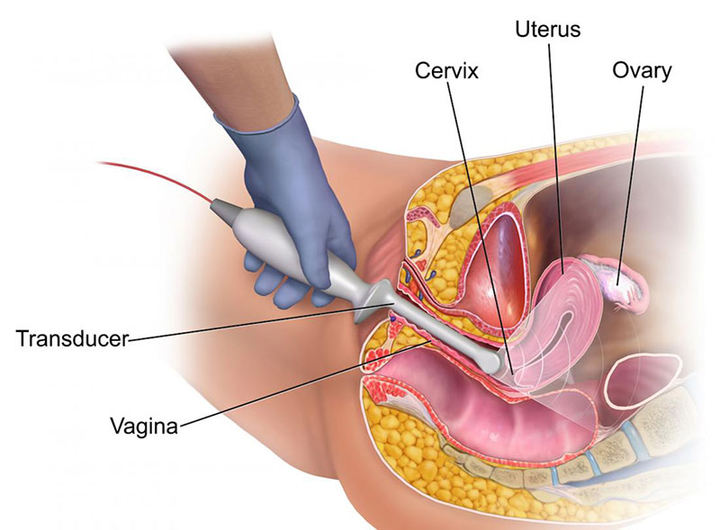 Hizmetler - Vajinal Ultrasonografi